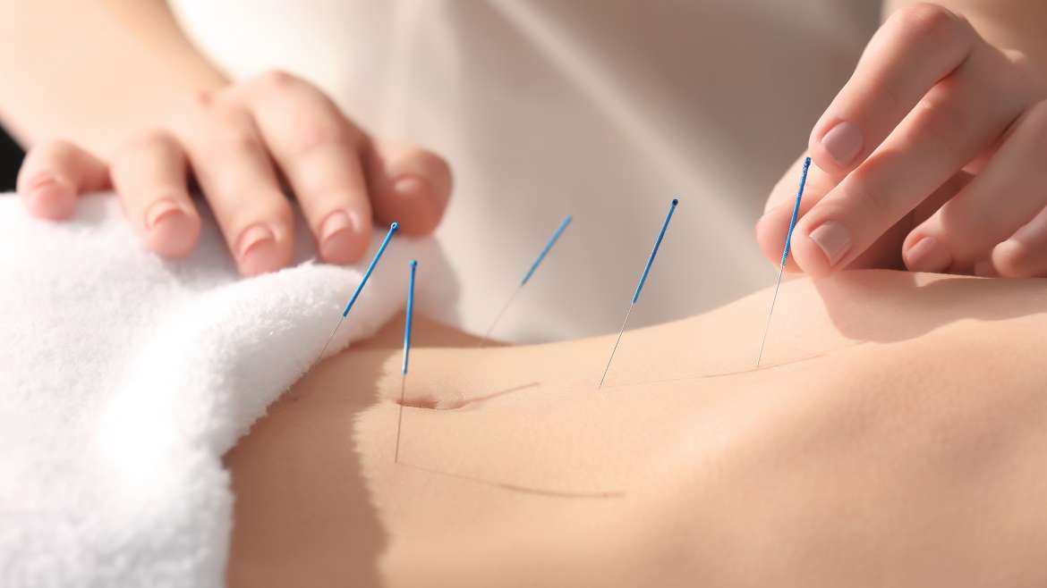 Acupuncture